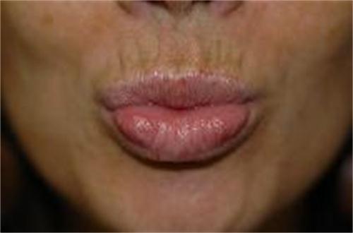 Fillers 2 dopo